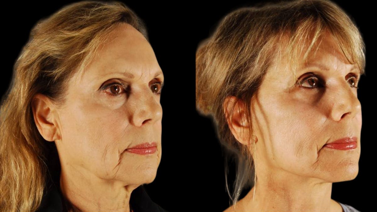 Mini Facelift Before & After Gallery - Patient 132903 - Image 4