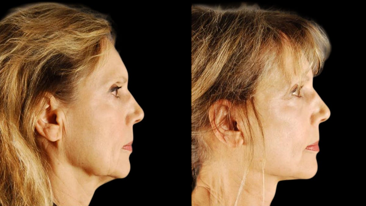 Mini Facelift Before & After Gallery - Patient 132903 - Image 5