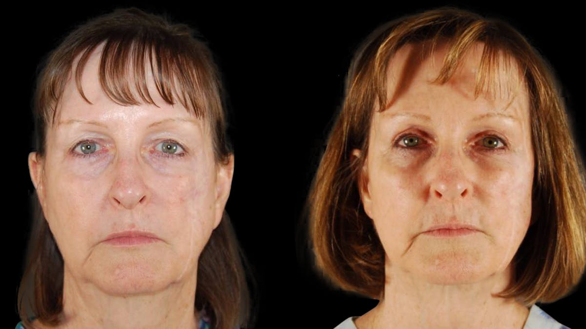 Mini Facelift Before & After Gallery - Patient 350043 - Image 1