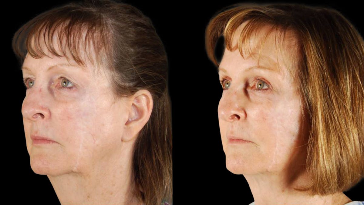 Mini Facelift Before & After Gallery - Patient 350043 - Image 2