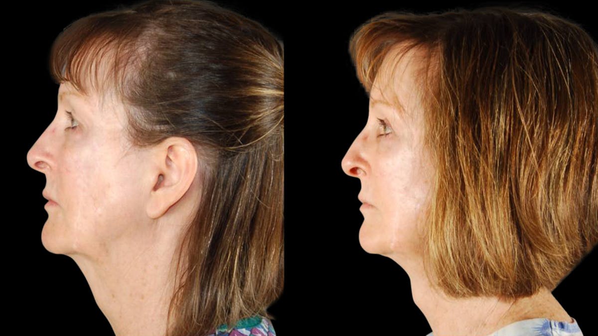Mini Facelift Before & After Gallery - Patient 350043 - Image 3