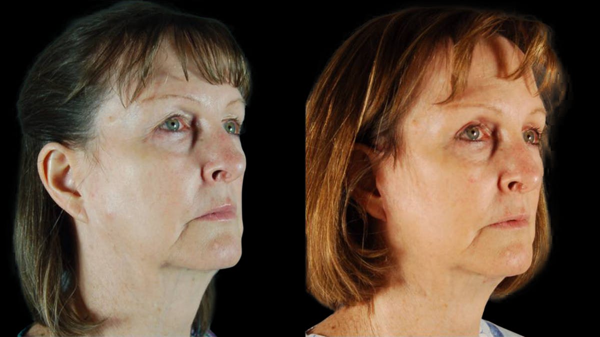 Mini Facelift Before & After Gallery - Patient 350043 - Image 4