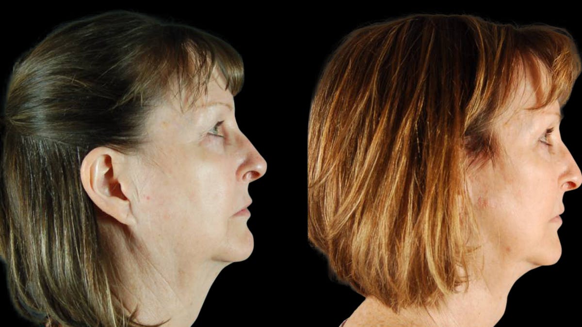 Mini Facelift Before & After Gallery - Patient 350043 - Image 5