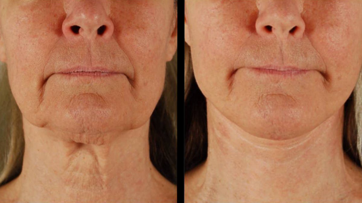 Mini Facelift Before & After Gallery - Patient 355507 - Image 3