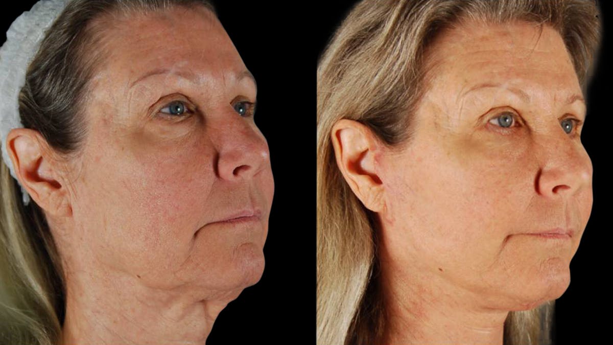 Mini Facelift Before & After Gallery - Patient 355507 - Image 2