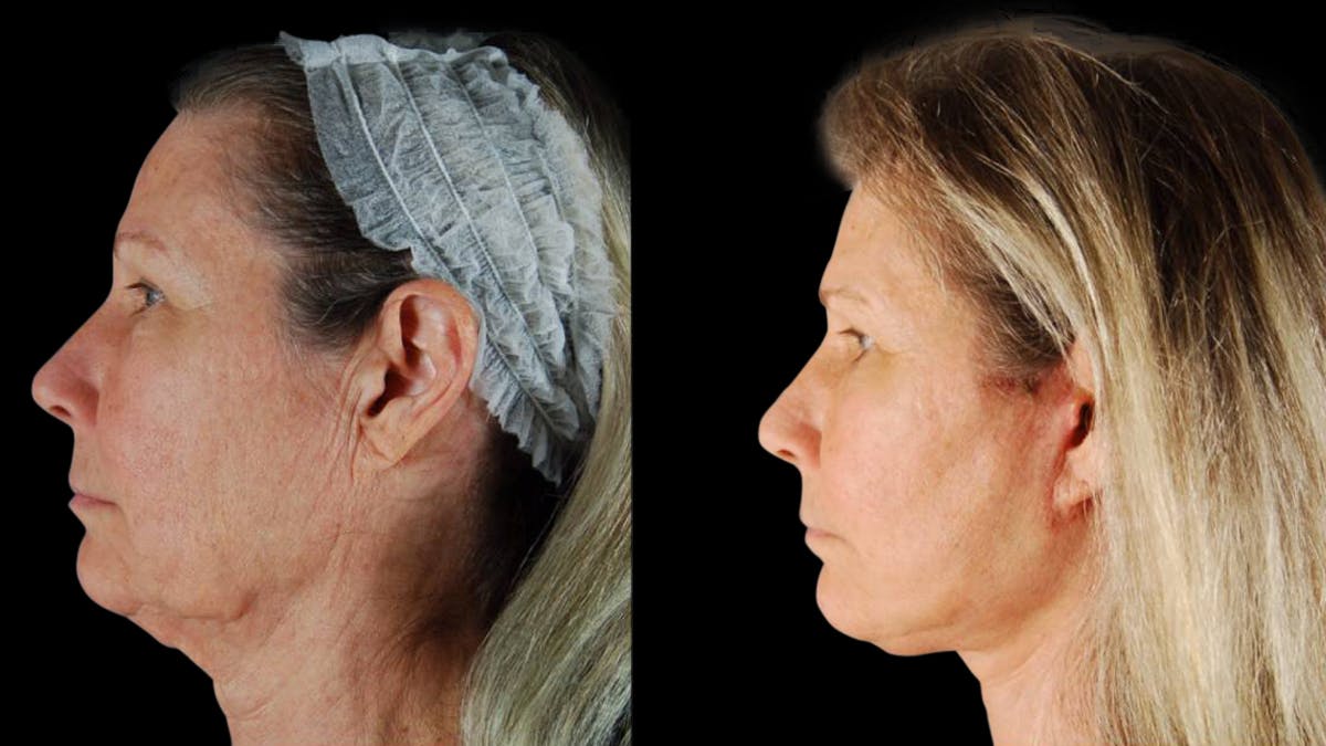 Mini Facelift Before & After Gallery - Patient 355507 - Image 4