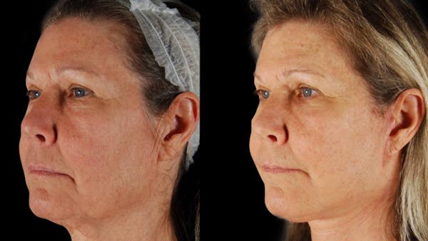 Neck Lift Before & After Gallery - Patient 224274 - Image 1
