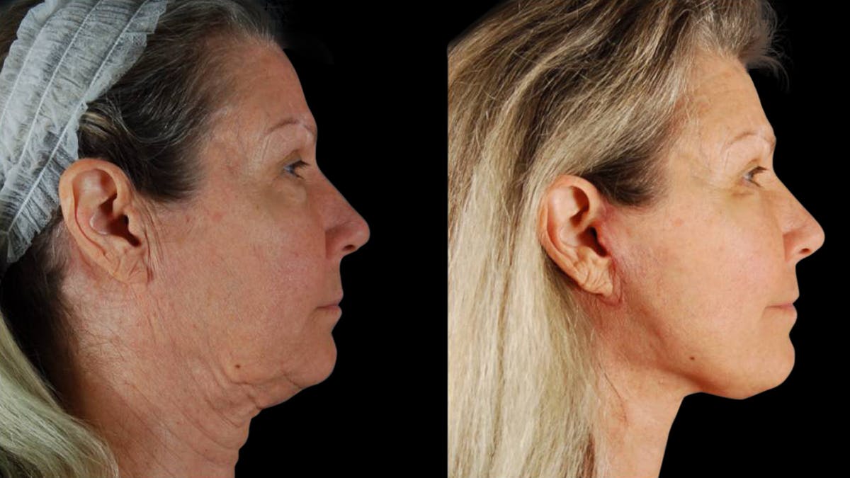 Mini Facelift Before & After Gallery - Patient 355507 - Image 5