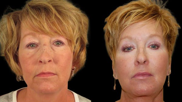 Neck Lift Before & After Gallery - Patient 194263 - Image 1