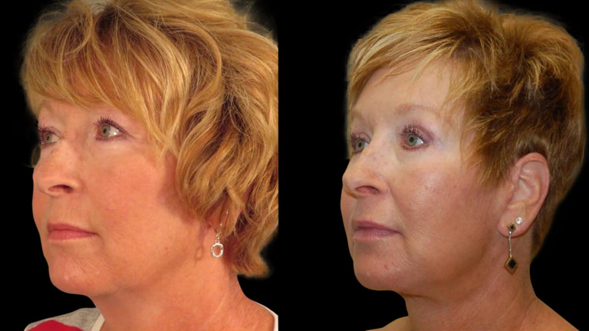 Neck Lift Before & After Gallery - Patient 194263 - Image 2
