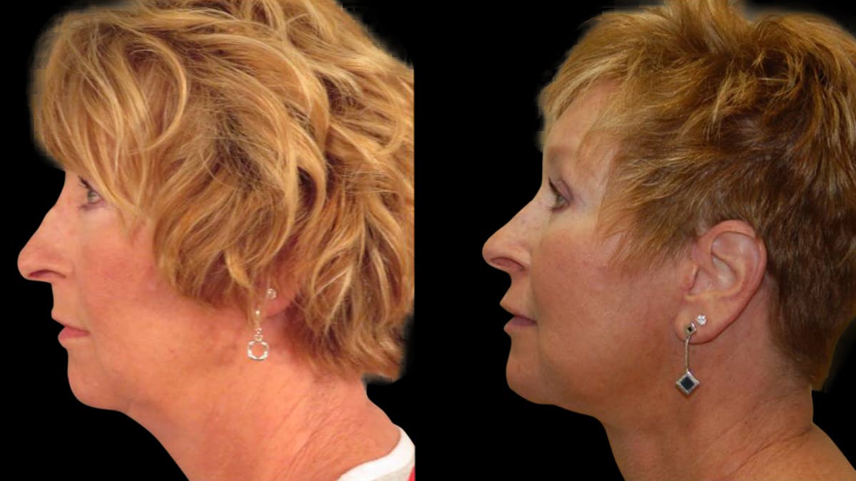 Neck Lift Before & After Gallery - Patient 194263 - Image 3