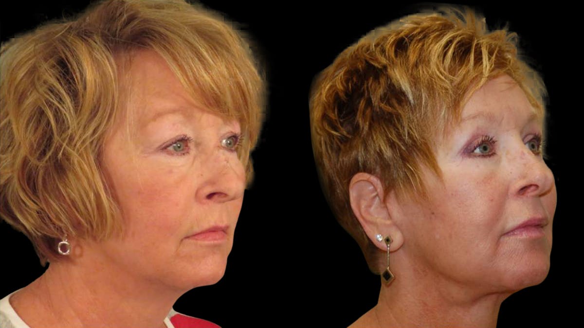 Neck Lift Before & After Gallery - Patient 194263 - Image 4