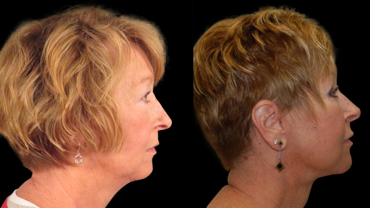 Neck Lift Before & After Gallery - Patient 194263 - Image 5