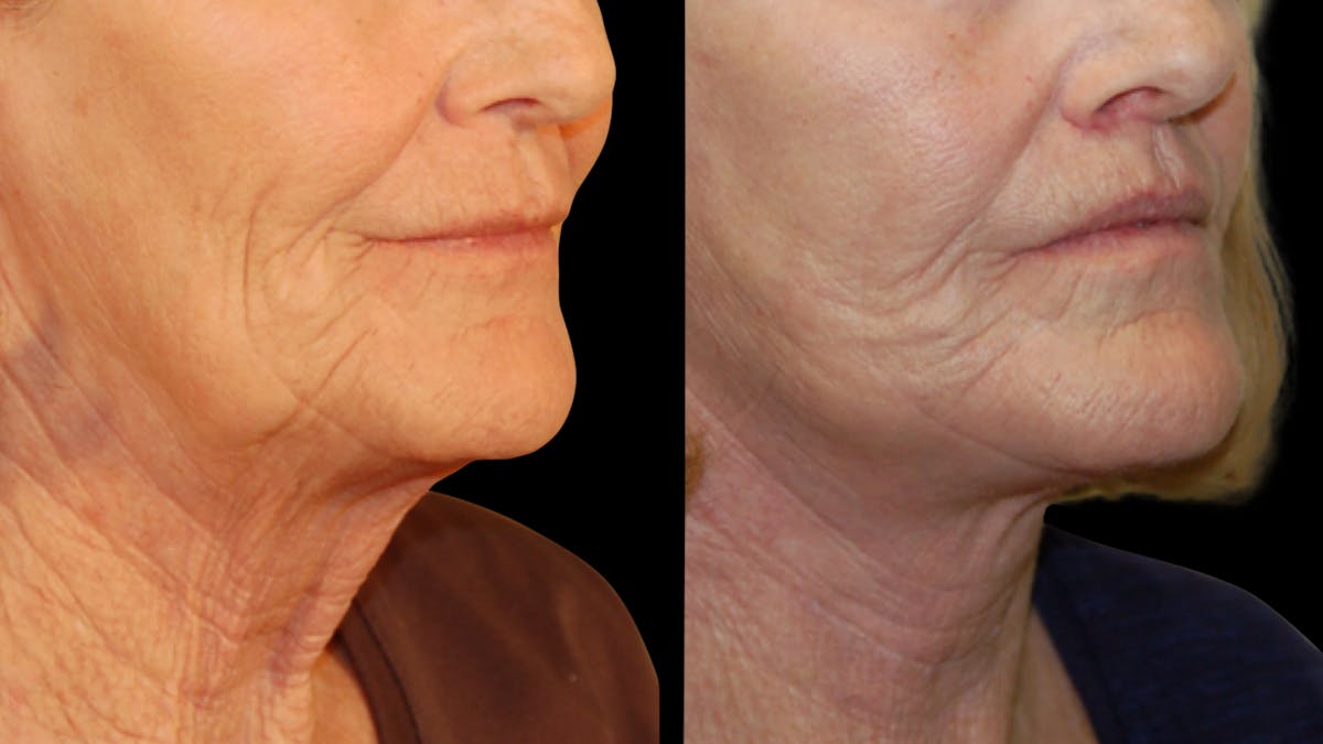 Neck Lift Before & After Gallery - Patient 128902 - Image 6