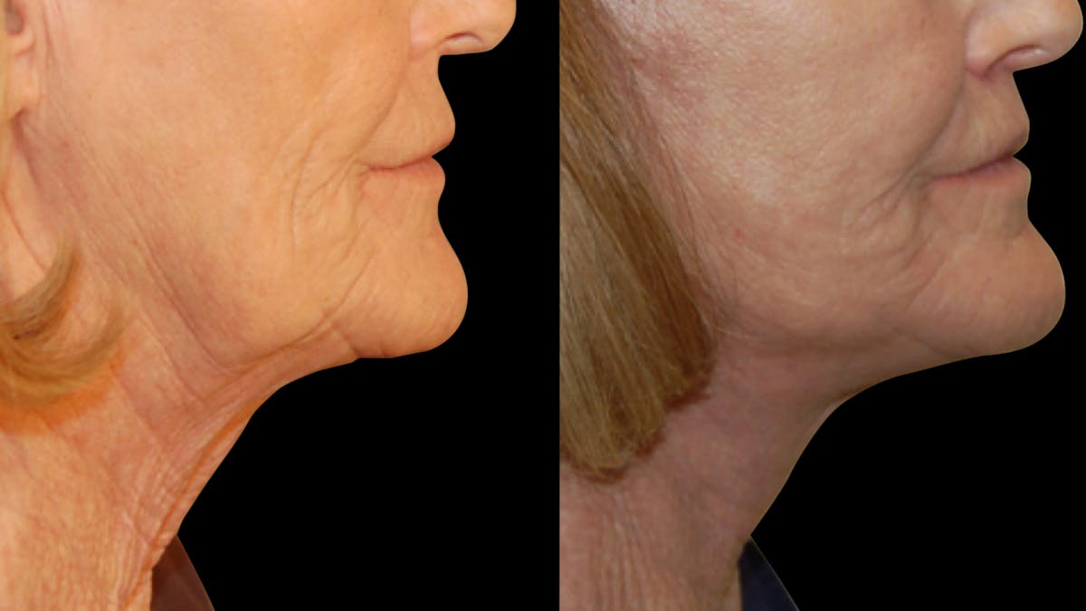 Neck Lift Before & After Gallery - Patient 128902 - Image 7