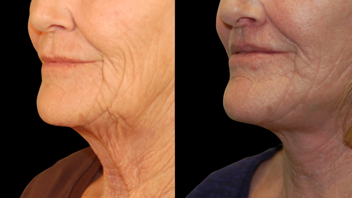 Neck Lift Before & After Gallery - Patient 128902 - Image 8