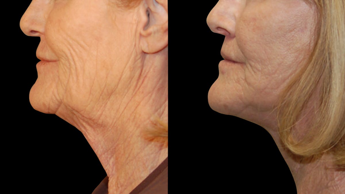 Neck Lift Before & After Gallery - Patient 128902 - Image 9