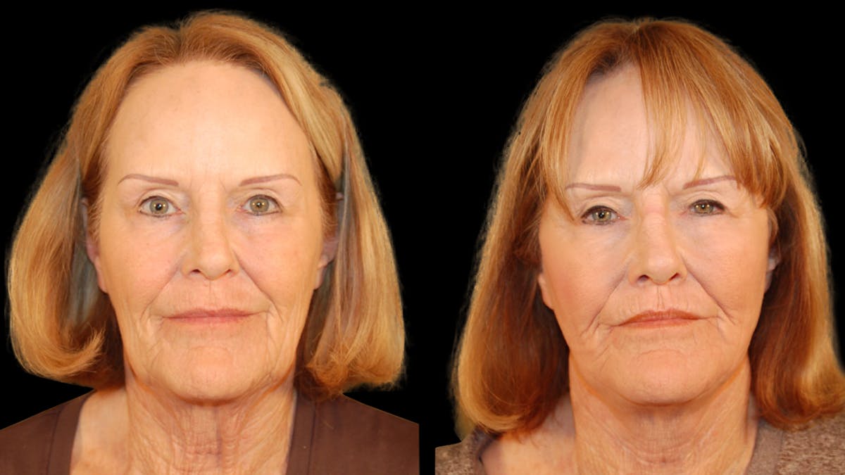 Neck Lift Before & After Gallery - Patient 128902 - Image 1