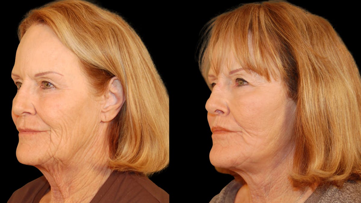 Neck Lift Before & After Gallery - Patient 128902 - Image 2