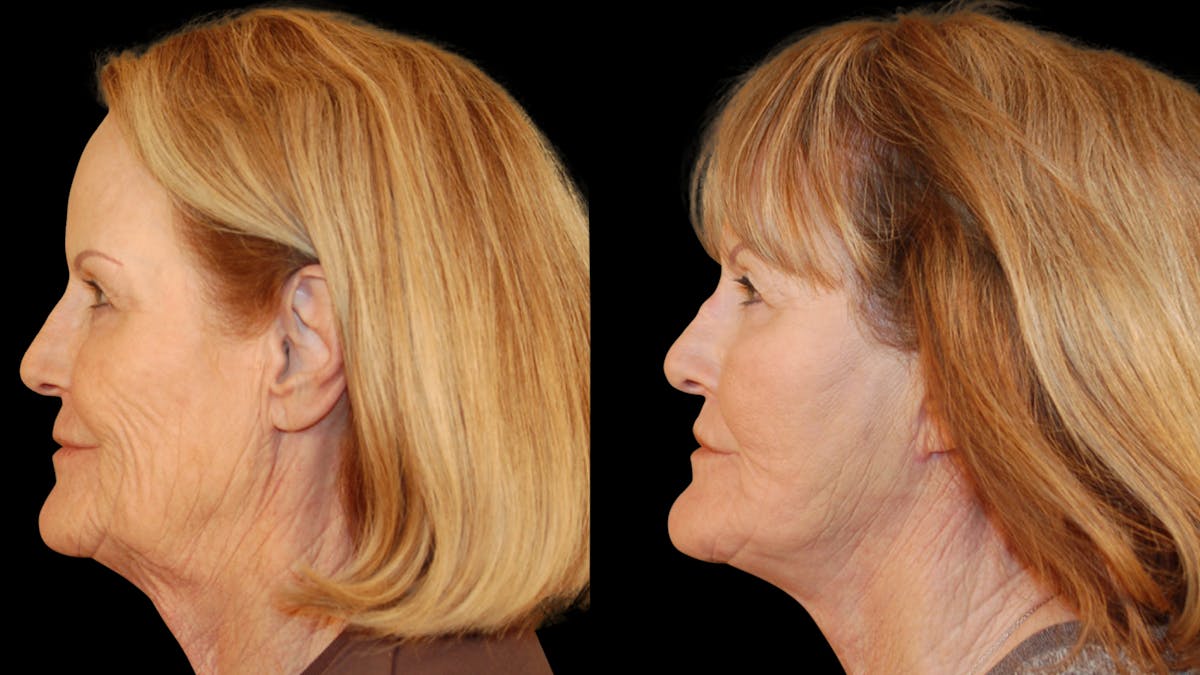 Neck Lift Before & After Gallery - Patient 128902 - Image 4