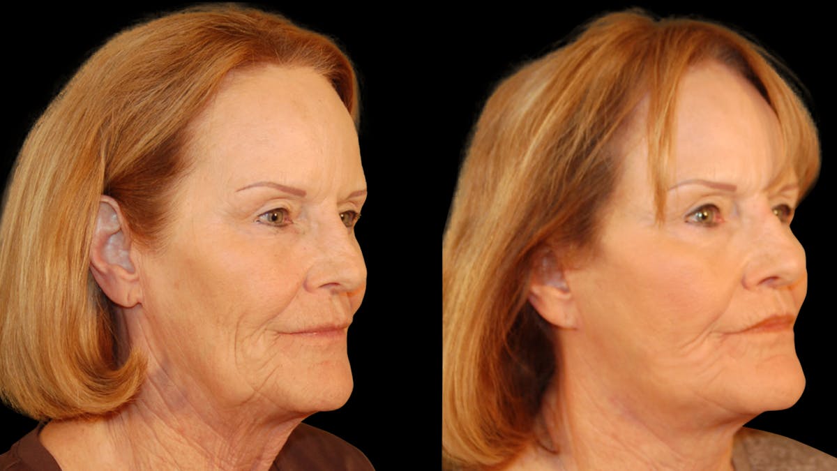Neck Lift Before & After Gallery - Patient 128902 - Image 3