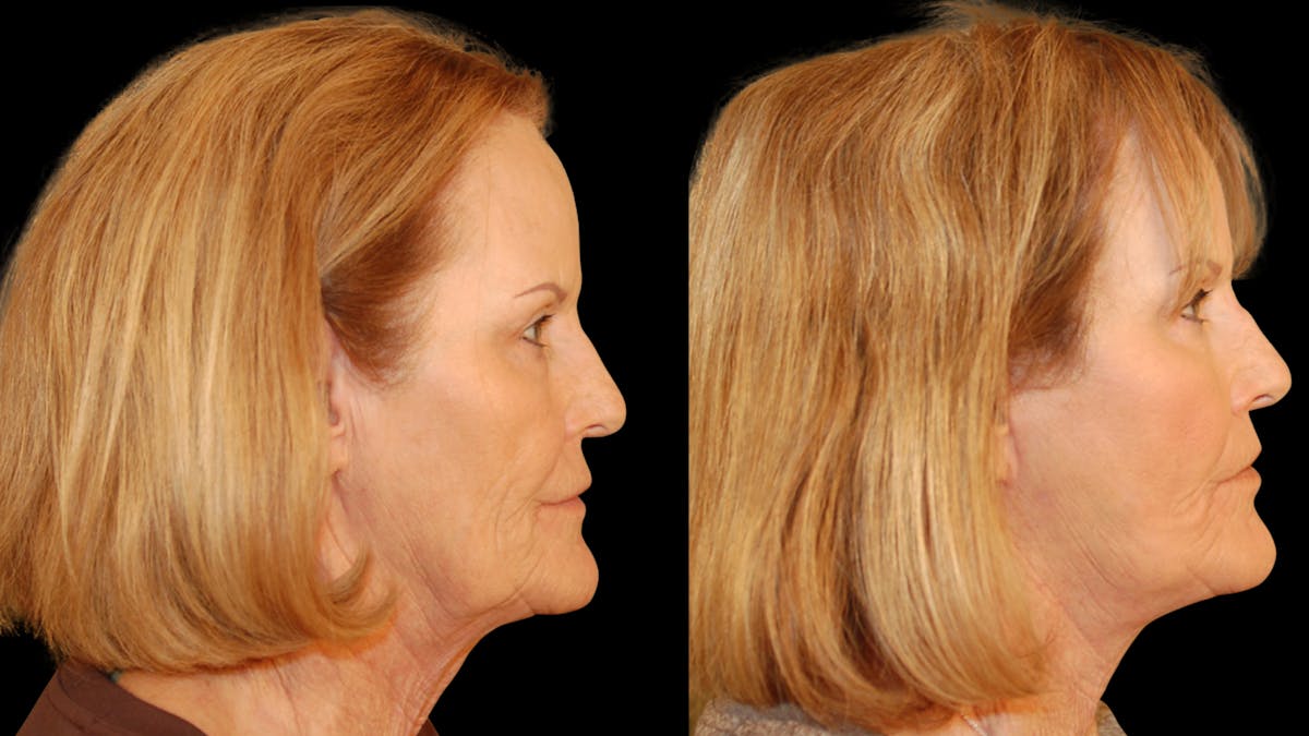 Neck Lift Before & After Gallery - Patient 128902 - Image 5