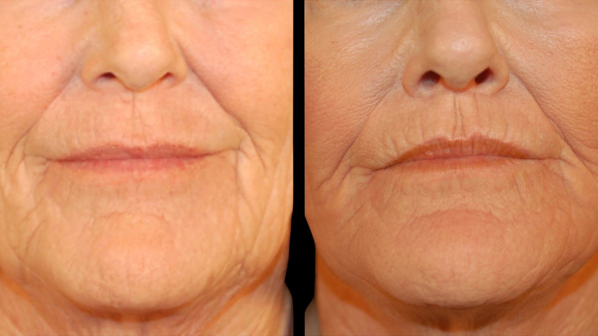 Neck Lift Before & After Gallery - Patient 128902 - Image 10