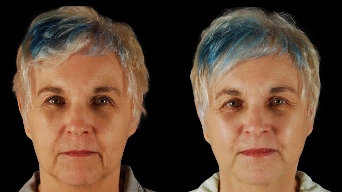 Neck Lift Before & After Gallery - Patient 219504 - Image 1