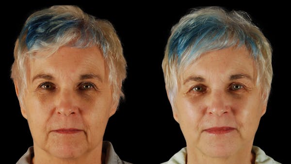 Neck Lift Before & After Gallery - Patient 219504 - Image 1