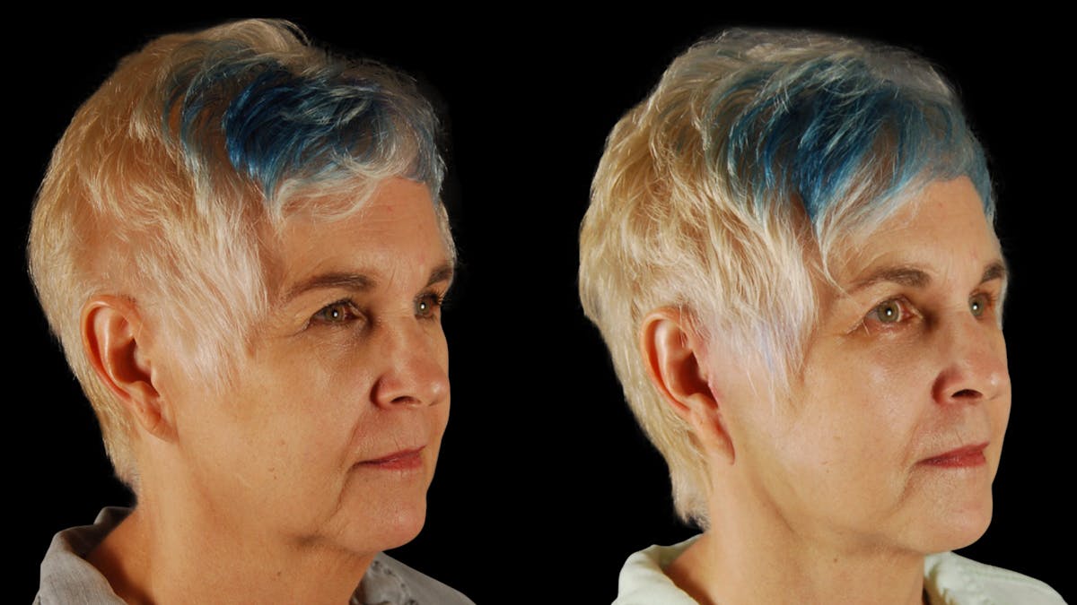 Neck Lift Before & After Gallery - Patient 219504 - Image 2