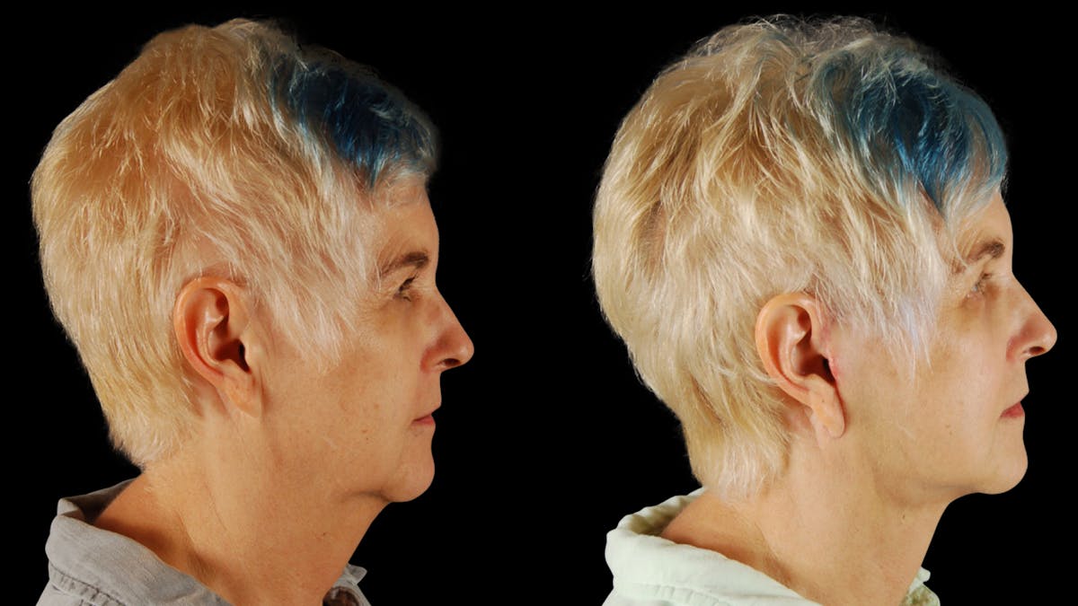 Neck Lift Before & After Gallery - Patient 219504 - Image 3