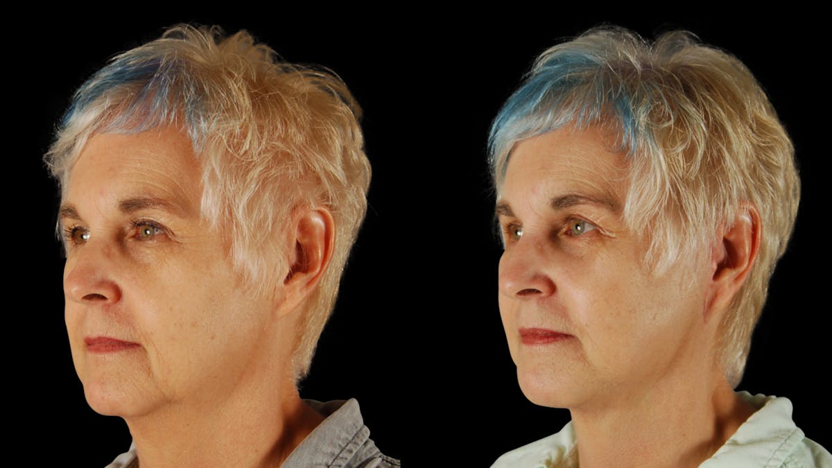 Neck Lift Before & After Gallery - Patient 219504 - Image 4