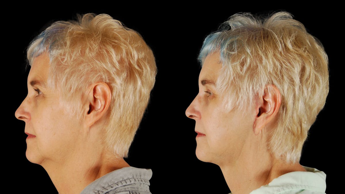 Neck Lift Before & After Gallery - Patient 219504 - Image 5