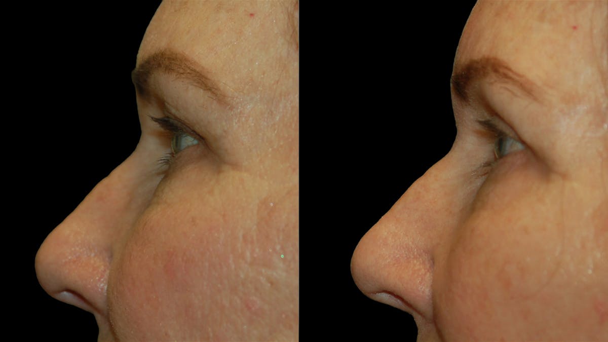 Mini Facelift Before & After Gallery - Patient 357071 - Image 6