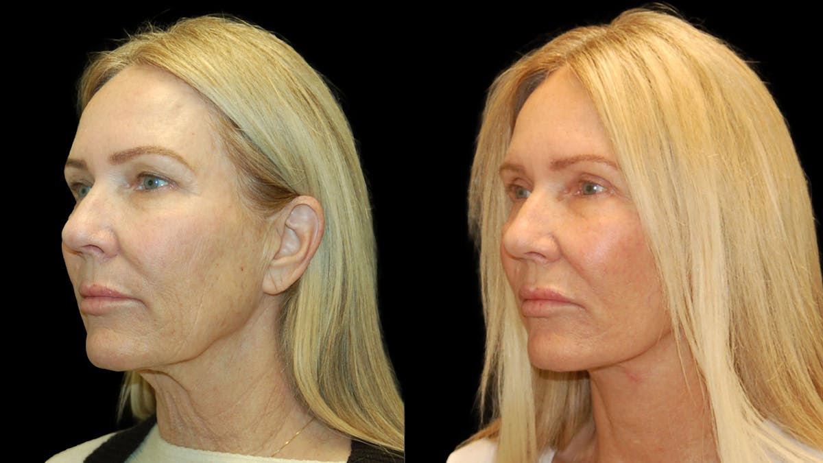Mini Facelift Before & After Gallery - Patient 357071 - Image 2