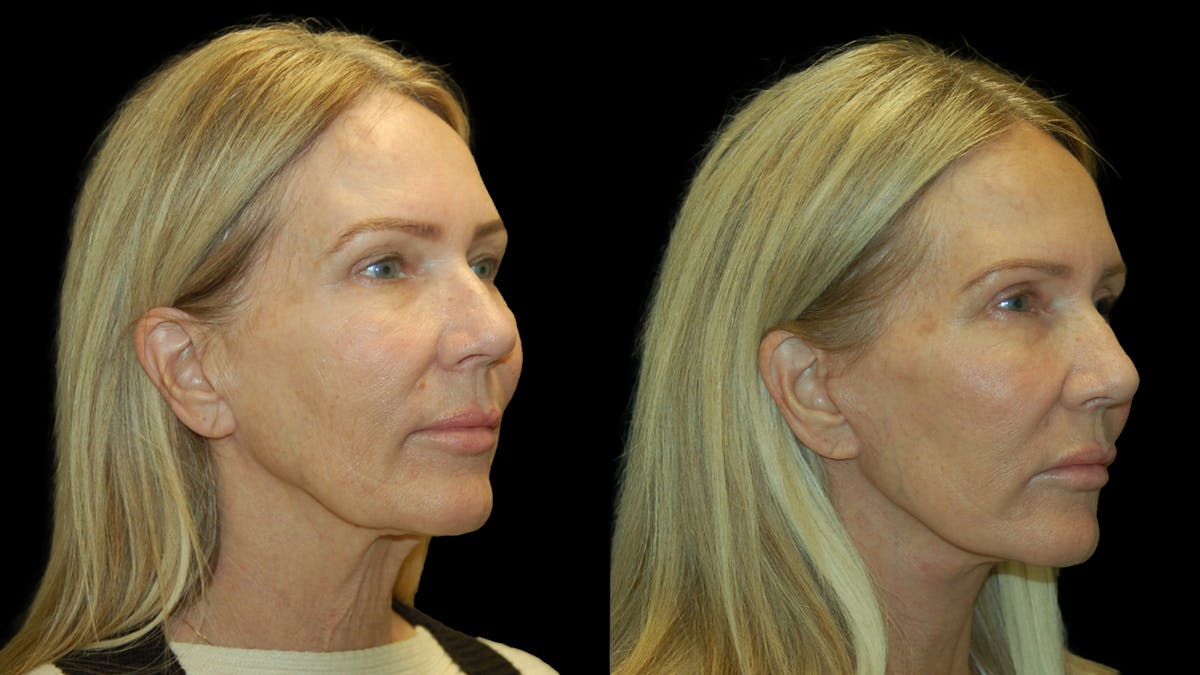 Mini Facelift Before & After Gallery - Patient 357071 - Image 3