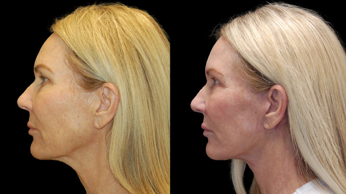 Mini Facelift Before & After Gallery - Patient 357071 - Image 4