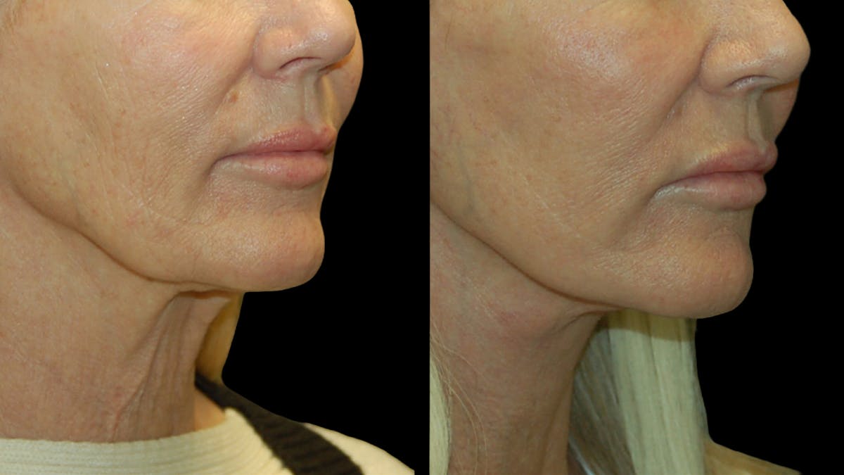 Mini Facelift Before & After Gallery - Patient 357071 - Image 9