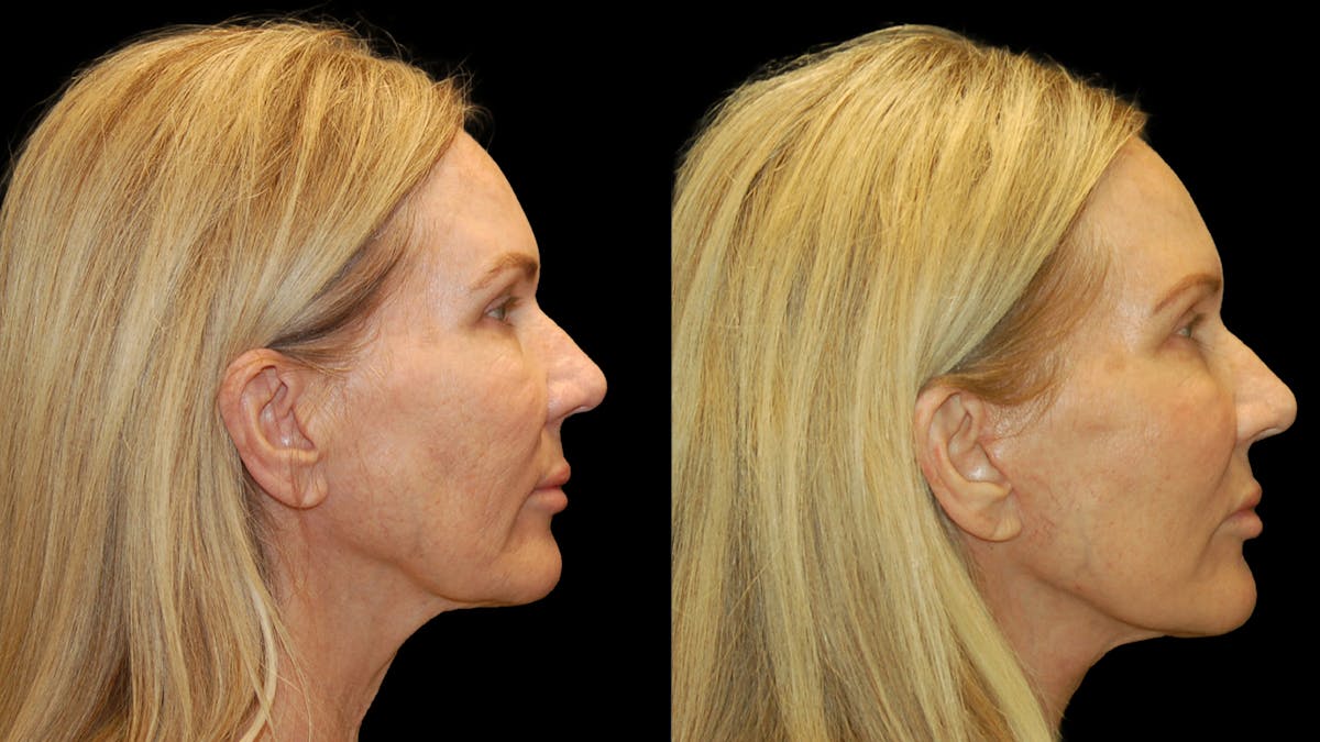 Mini Facelift Before & After Gallery - Patient 357071 - Image 5