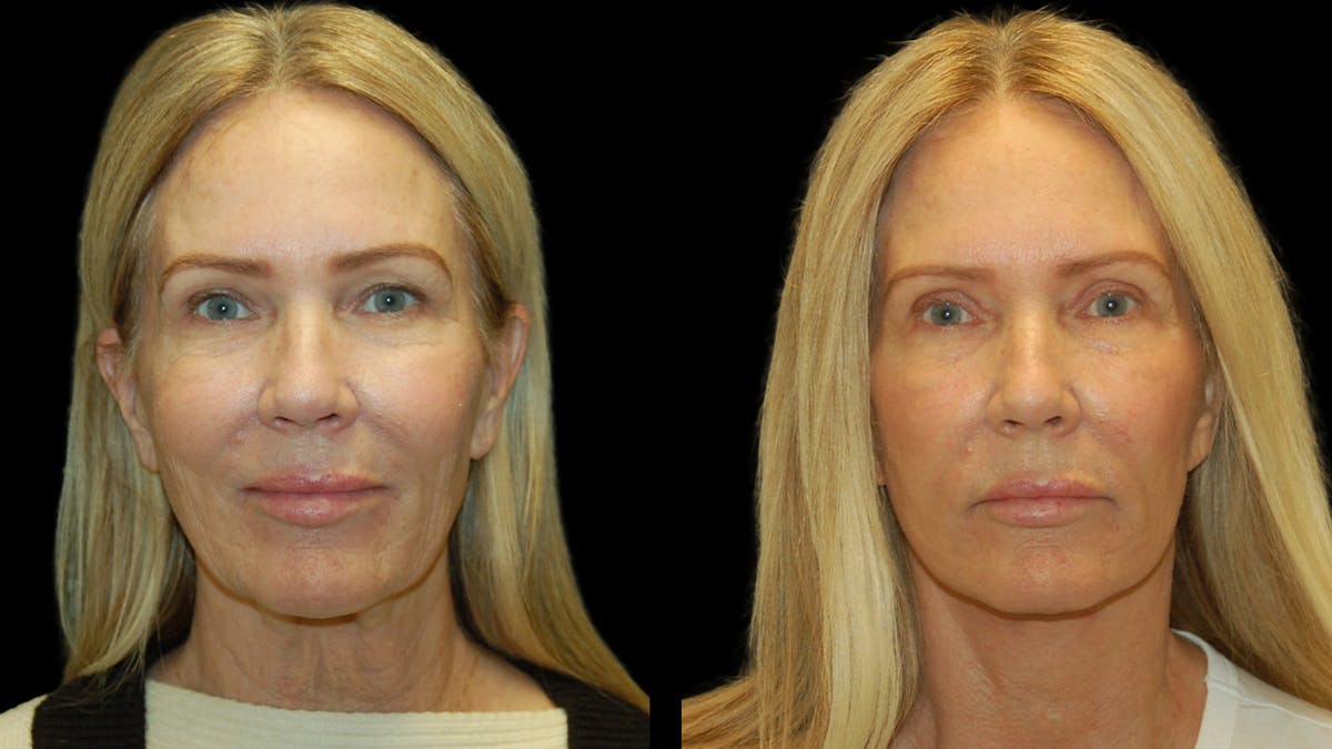 Mini Facelift Before & After Gallery - Patient 357071 - Image 1