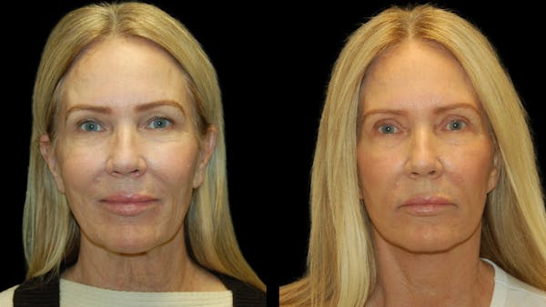 Mini Facelift Before & After Gallery - Patient 357071 - Image 1