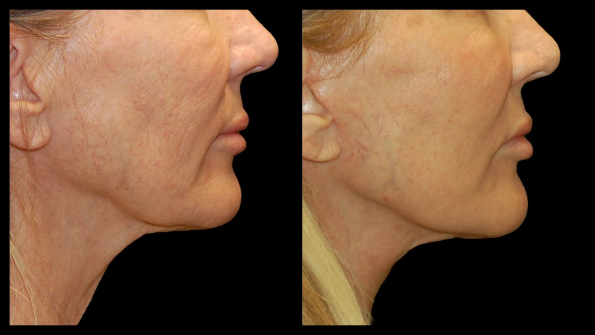 Mini Facelift Before & After Gallery - Patient 357071 - Image 10