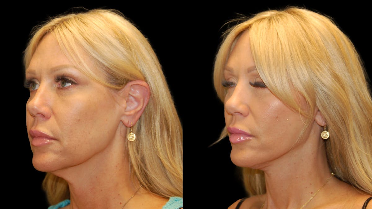 Mini Facelift Before & After Gallery - Patient 177429 - Image 2