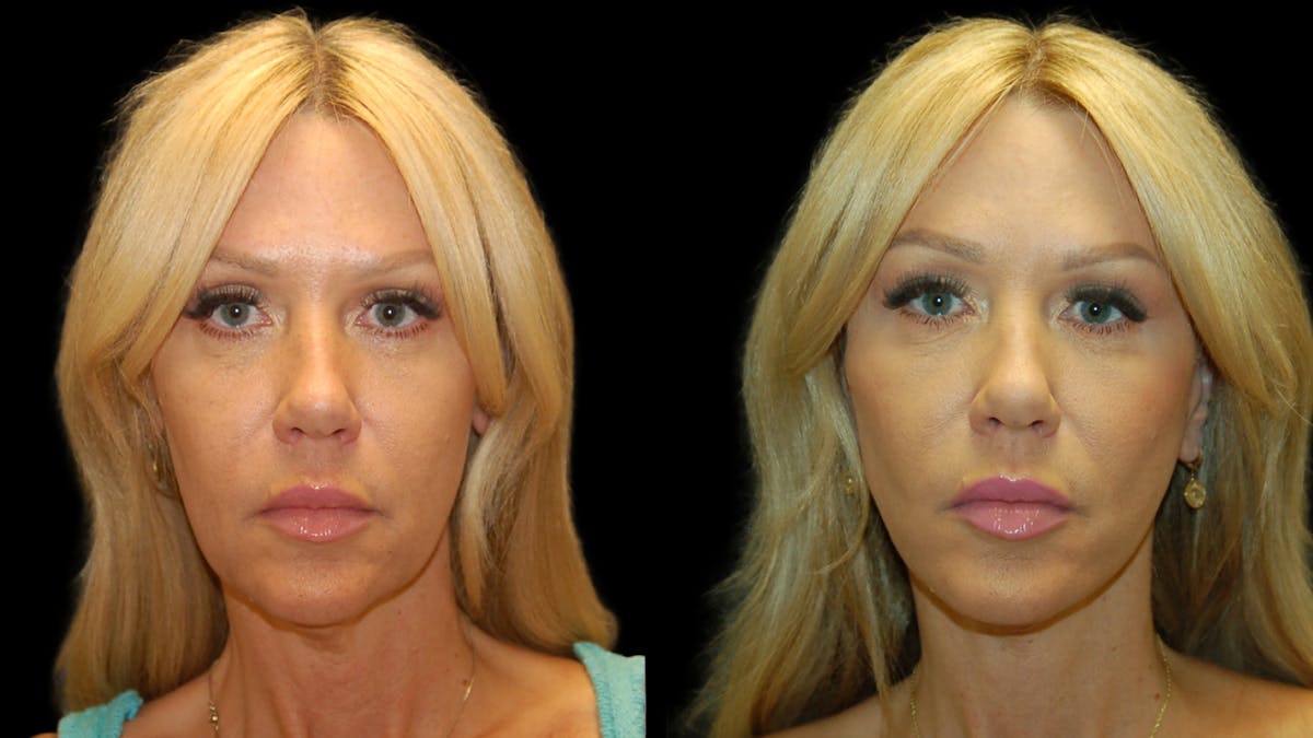 Mini Facelift Before & After Gallery - Patient 177429 - Image 1
