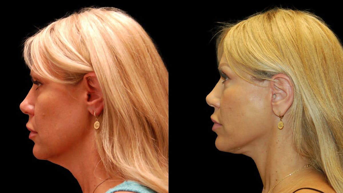Mini Facelift Before & After Gallery - Patient 177429 - Image 3