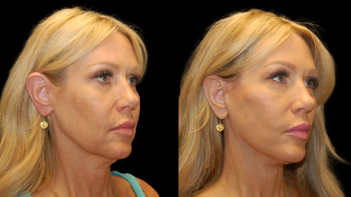 Mini Facelift Before & After Gallery - Patient 177429 - Image 4