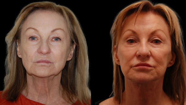 Neck Lift Before & After Gallery - Patient 839976 - Image 1
