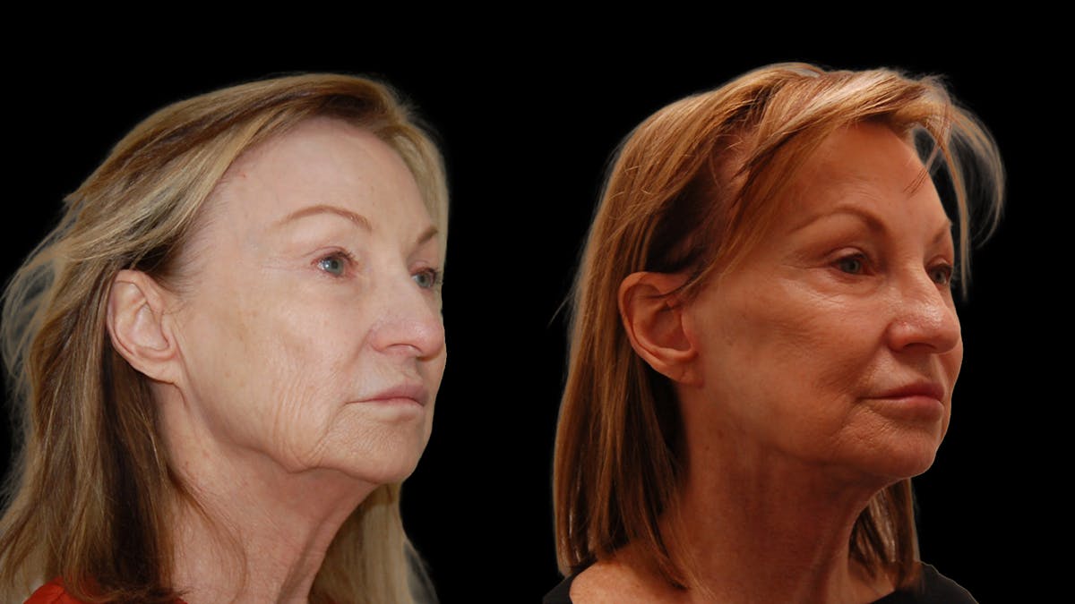 Neck Lift Before & After Gallery - Patient 839976 - Image 2