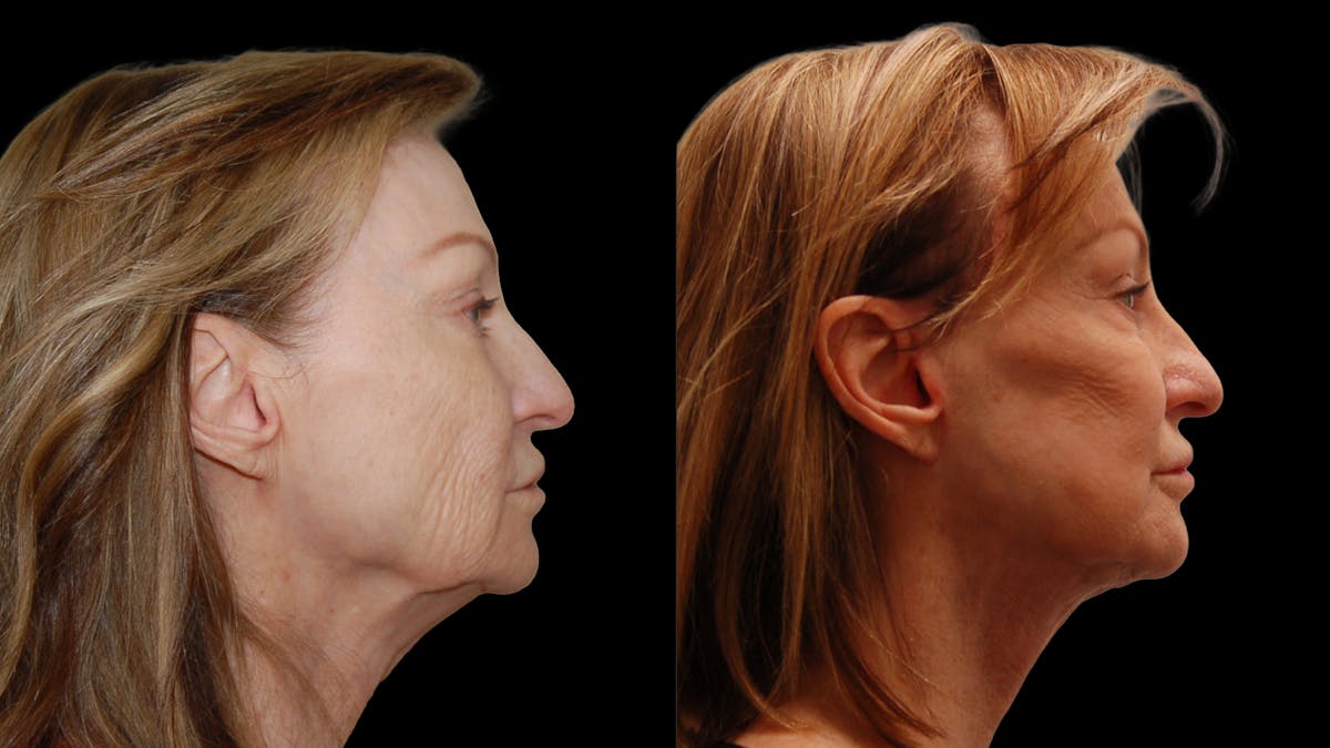 Neck Lift Before & After Gallery - Patient 839976 - Image 3