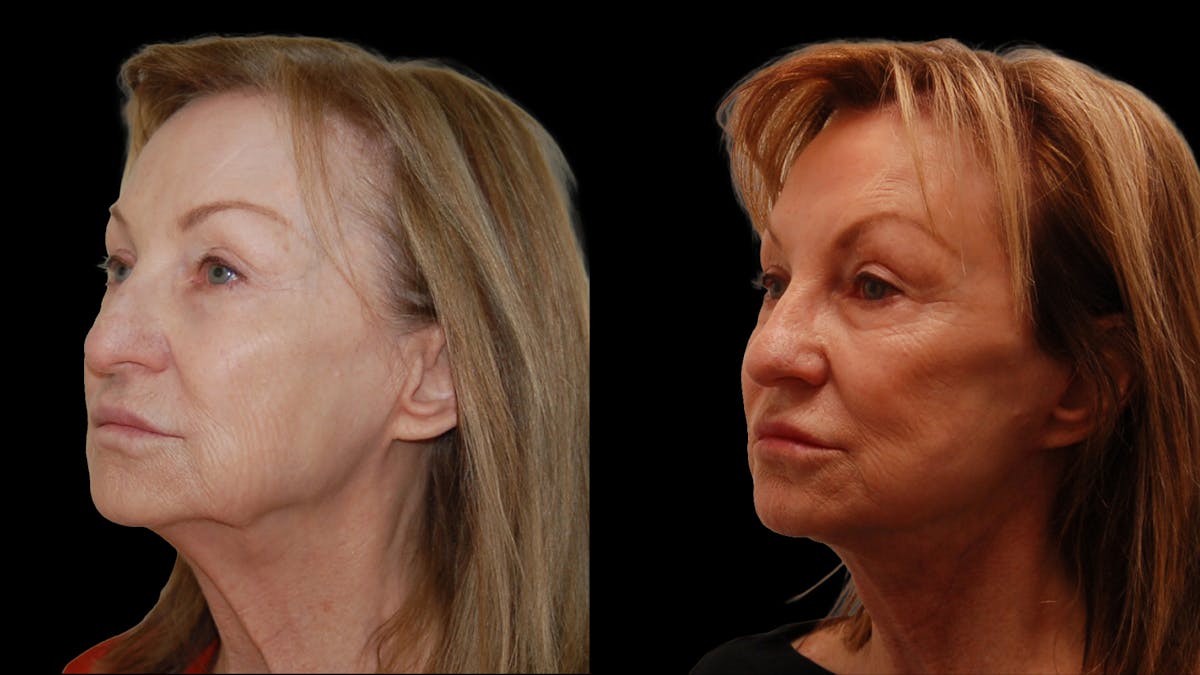 Neck Lift Before & After Gallery - Patient 839976 - Image 4